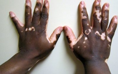 VITILIGO: THE NEED FOR AWARENESS