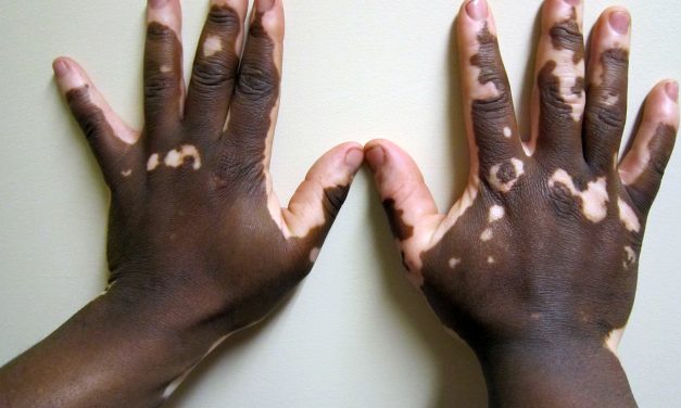 VITILIGO: THE NEED FOR AWARENESS